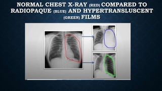 NORMAL CHEST X-RAY (RED) COMPARED TO
RADIOPAQUE (BLUE) AND HYPERTRANSLUSCENT
(GREEN) FILMS
 