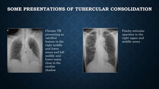 SOME PRESENTATIONS OF TUBERCULAR CONSOLIDATION
Chronic TB
presenting as
calcified
lesions in the
right middle
and lower
zones and left
middle and
lower zones
close to the
cardiac
shadow.
Patchy reticular
opacities in the
right upper and
middle zones .
 