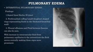 • INTERSTITIAL PULMONARY EDEMA
Findings:
1.Septal lines( Kerley B Lines)
2. Peribronchial cuffing (small doughnut shaped
rings representing fluids in the thickened bronchial
wall)
3. Pleural effusions and Fluid between fissures
can also be seen.
With increase in extravascular fluid from
pulmonary capillaries to the interstitium the fluid
moves centrally making these signs more
prominent.
PULMONARY EDEMA
 