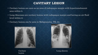 CAVITARY LESION
• Cavitary lesions are seen as an area of radiopaque margin with hypertransluscent
area within it.
• Lung Abscesses are cavitary lesions with radiopaque margin and having an air-fluid
level within it.
• Cavitary lesions can be seen in Malignancies, TB, etc.
Lung abscessCavitary
Lesion
 