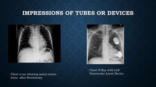 IMPRESSIONS OF TUBES OR DEVICES
Chest X-Ray with Left
Ventricular Assist DeviceChest x-ray showing metal suture
wires after Sternotomy
 