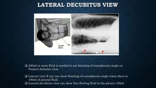 LATERAL DECUBITUS VIEW
 200ml or more fluid is needed to see blunting of costophrenic angle on
Postero-Anterior view.
 Lateral view X-ray can show blunting of costophrenic angle when there is
100ml of pleural fluid.
 Lateral decubitus view can show free flowing fluid in the pleura <50ml
 