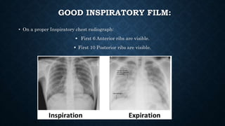 GOOD INSPIRATORY FILM:
• On a proper Inspiratory chest radiograph:
 First 6 Anterior ribs are visible.
 First 10 Posterior ribs are visible.
 