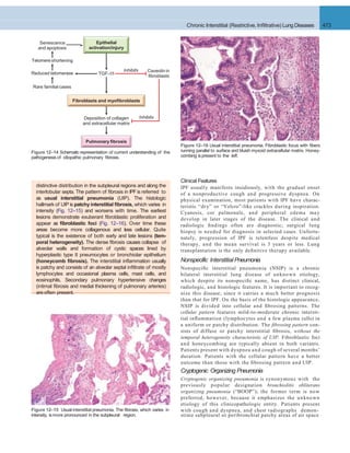 Chronic Interstitial (Restrictive, Inﬁltrative) Lung Diseases 473
Pulmonary fibrosis
Deposition of collagen
and extracellular matrix
Epithelial
activation/injury
TGF-1
Caveolin in
fibroblasts
Reduced telomerase
Telomere shortening
Senescence
and apoptosis
Rare familial cases
Fibroblasts and myofibroblasts
Inhibits
Inhibits
Figure 12–14 Schematic representation of current understanding of the
pathogenesis of idiopathic pulmonary ﬁbrosis.
Figure 12–15 Usual interstitial pneumonia. The ﬁbrosis, which varies in
distinctive distribution in the subpleural regions and along the
interlobular septa. The pattern of ﬁbrosis in IPFis referred to
as usual interstitial pneumonia (UIP). The histologic
hallmark of UIP is patchy interstitial ﬁbrosis, which varies in
intensity (Fig. 12–15) and worsens with time. The earliest
lesions demonstrate exuberant ﬁbroblastic proliferation and
appear as ﬁbroblastic foci (Fig. 12–16). Over time these
areas become more collagenous and less cellular. Quite
typical is the existence of both early and late lesions (tem-
poral heterogeneity). The dense ﬁbrosis causes collapse of
alveolar walls and formation of cystic spaces lined by
hyperplastic type II pneumocytes or bronchiolar epithelium
(honeycomb ﬁbrosis). The interstitial inﬂammation usually
is patchy and consists of an alveolar septal inﬁltrate of mostly
lymphocytes and occasional plasma cells, mast cells, and
eosinophils. Secondary pulmonary hypertensive changes
(intimal ﬁbrosis and medial thickening of pulmonary arteries)
are often present.
Figure 12–16 Usual interstitial pneumonia. Fibroblastic focus with ﬁbers
running parallel to surface and bluish myxoid extracellular matrix. Honey-
combing ispresent to the left.
strate subpleural or peribronchial patchy areas of air spaceintensity, ismore pronounced in the subpleural region.
Clinical Features
IPF usually manifests insidiously, with the gradual onset
of a nonproductive cough and progressive dyspnea. On
physical examination, most patients with IPF have charac-
teristic “dry” or “Velcro”-like crackles during inspiration.
Cyanosis, cor pulmonale, and peripheral edema may
develop in later stages of the disease. The clinical and
radiologic ﬁndings often are diagnostic; surgical lung
biopsy is needed for diagnosis in selected cases. Unfortu-
nately, progression of IPF is relentless despite medical
therapy, and the mean survival is 3 years or less. Lung
transplantation is the only deﬁnitive therapy available.
Nonspecific Interstitial Pneumonia
Nonspeciﬁc interstitial pneumonia (NSIP) is a chronic
bilateral interstitial lung disease of unknown etiology,
which despite its nonspeciﬁc name, has distinct clinical,
radiologic, and histologic features. It is important to recog-
nize this disease, since it carries a much better prognosis
than that for IPF. On the basis of the histologic appearance,
NSIP is divided into cellular and ﬁbrosing patterns. The
cellular pattern features mild-to-moderate chronic intersti-
tial inﬂammation (lymphocytes and a few plasma cells) in
a uniform or patchy distribution. The ﬁbrosing pattern con-
sists of diffuse or patchy interstitial ﬁbrosis, without the
temporal heterogeneity characteristic of UIP. Fibroblastic foci
and honeycombing are typically absent in both variants.
Patients present with dyspnea and cough of several months’
duration. Patients with the cellular pattern have a better
outcome than those with the ﬁbrosing pattern and UIP.
Cryptogenic Organizing Pneumonia
Cryptogenic organizing pneumonia is synonymous with the
previously popular designation bronchiolitis obliterans
organizing pneumonia (“BOOP”); the former term is now
preferred, however, because it emphasizes the unknown
etiology of this clinicopathologic entity. Patients present
with cough and dyspnea, and chest radiographs demon-
 