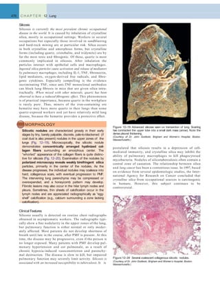 postulated that silicosis results in a depression of cell-
mediated immunity, and crystalline silica may inhibit the
ability of pulmonary macrophages to kill phagocytosed
mycobacteria. Nodules of silicotuberculosis often contain a
central zone of caseation. The relationship between silica
and lung cancer has been a contentious issue. In 1997, based
on evidence from several epidemiologic studies, the Inter-
national Agency for Research on Cancer concluded that
crystalline silica from occupational sources is carcinogenic
in humans. However, this subject continues to be
controversial.
476 C H A P T E R 12 Lung
Silicosis
Silicosis is currently the most prevalent chronic occupational
disease in the world. It is caused by inhalation of crystalline
silica, mostly in occupational settings. Workers in several
occupations but especially those involved in sandblasting
and hard-rock mining are at particular risk. Silica occurs
in both crystalline and amorphous forms, but crystalline
forms (including quartz, cristobalite, and tridymite) are by
far the most toxic and ﬁbrogenic. Of these, quartz is most
commonly implicated in silicosis. After inhalation the
particles interact with epithelial cells and macrophages.
Ingested silica particles cause activation and release of mediators
by pulmonary macrophages, including IL-1, TNF, ﬁbronectin,
lipid mediators, oxygen-derived free radicals, and ﬁbro-
genic cytokines. Especially compelling is the evidence
incriminating TNF, since anti-TNF monoclonal antibodies
can block lung ﬁbrosis in mice that are given silica intra-
tracheally. When mixed with other minerals, quartz has been
observed to have a reduced ﬁbrogenic effect. This phenomenon
is of practical importance, because quartz in the workplace
is rarely pure. Thus, miners of the iron-containing ore
hematite may have more quartz in their lungs than some
quartz-exposed workers and yet have relatively mild lung
disease, because the hematite provides a protective effect.
MORPHOLOGY
Silicotic nodules are characterized grossly in their early
stages by tiny, barely palpable, discrete, pale-to-blackened (if
coal dust is also present) nodules in the upper zones of the
lungs (Fig. 12–19). Microscopically, the silicotic nodule
demonstrates concentrically arranged hyalinized col-
lagen ﬁbers surrounding an amorphous center. The
“whorled” appearance of the collagen ﬁbers is quite distinc-
tive for silicosis (Fig. 12–20). Examination of the nodules by
polarized microscopy reveals weakly birefringent silica
particles, primarily in the center of the nodules. As the
disease progresses, the individual nodules may coalesce into
hard, collagenous scars, with eventual progression to PMF.
The intervening lung parenchyma may be compressed or
overexpanded, and a honeycomb pattern may develop.
Fibrotic lesions may also occur in the hilar lymph nodes and
pleura. Sometimes, thin sheets of calciﬁcation occur in the
lymph nodes and are appreciated radiographically as “egg-
shell” calciﬁcation (e.g., calcium surrounding a zone lacking
calciﬁcation).
Figure 12–19 Advanced silicosis seen on transection of lung. Scarring
has contracted the upper lobe into a small dark mass (arrow). Note the
dense pleural thickening.
(Courtesy of Dr. John Godleski, Brigham and Women’s Hospital, Boston,
Massachusetts.)
Clinical Features
Silicosis usually is detected on routine chest radiographs
obtained in asymptomatic workers. The radiographs typi-
cally show a ﬁne nodularity in the upper zones of the lung,
but pulmonary function is either normal or only moder-
ately affected. Most patients do not develop shortness of
breath until late in the course, after PMF is present. At this
time, the disease may be progressive, even if the person is
no longer exposed. Many patients with PMF develop pul-
monary hypertension and cor pulmonale, as a result of
chronic hypoxia-induced vasoconstriction and parenchy-
mal destruction. The disease is slow to kill, but impaired
pulmonary function may severely limit activity. Silicosis is
associated with an increased susceptibility to tuberculosis. It is
Figure 12–20 Several coalescent collagenous silicotic nodules.
(Courtesy of Dr. John Godleski, Brigham and Women’s Hospital, Boston,
Massachusetts.)
 