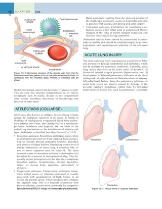 460 C H A P T E R
12
Lung
Type I
pneumocyte
Type II pneumocyte
Endothelium
Figure 12–1 Microscopic structure of the alveolar wall. Note that the
basement membrane (yellow) is thin on one side and widened where it is
continuous with the interstitial space. Portions of interstitial cells are
shown.
Endothelium
Interstitial
cell
TypeI
pneumocyte
ALVEOLAR SPACE
ALVEOLAR
SPACE
CAPILLARY
LUMEN
Resorption
(pneumothorax) also leads to compression atelectasis. Figure 12–2 Various forms of acquired atelectasis.
Compression
Contraction
(2) the interstitium, and (3) the pulmonary vascular system.
This division into discrete compartments is, of course,
deceptively neat. In reality, disease in one compartment
often causes secondary alterations of morphology and
function in other areas.
ATELECTASIS (COLLAPSE)
Atelectasis, also known as collapse, is loss of lung volume
caused by inadequate expansion of air spaces. It results in
shunting of inadequately oxygenated blood from pulmo-
nary arteries into veins, thus giving rise to a ventilation-
perfusion imbalance and hypoxia. On the basis of the
underlying mechanism or the distribution of alveolar col-
lapse, atelectasis is classiﬁed into three forms (Fig. 12–2).
• Resorption atelectasis. Resorption atelectasis occurs when
an obstruction prevents air from reaching distal airways.
The air already present gradually becomes absorbed,
and alveolar collapse follows. Depending on the level of
airway obstruction, an entire lung, a complete lobe, or
one or more segments may be involved. The most
common cause of resorption collapse is obstruction of a
bronchus by a mucous or mucopurulent plug. This fre-
quently occurs postoperatively but also may complicate
bronchial asthma, bronchiectasis, chronic bronchitis,
tumor, or foreign body aspiration, particularly in
children.
• Compression atelectasis. Compression atelectasis (some-
times called passive or relaxation atelectasis) is usually
associated with accumulation of ﬂuid, blood, or air
within the pleural cavity, which mechanically collapses
the adjacent lung. This is a frequent occurrence with
pleural effusion, caused most commonly by congestive
heart failure (CHF). Leakage of air into the pleural cavity
Basal atelectasis resulting from the elevated position of
the diaphragm commonly occurs in bedridden patients,
in patients with ascites, and during and after surgery.
• Contraction atelectasis. Contraction (or cicatrization) ate-
lectasis occurs when either local or generalized ﬁbrotic
changes in the lung or pleura hamper expansion and
increase elastic recoil during expiration.
Atelectasis (except when caused by contraction) is poten-
tially reversible and should be treated promptly to prevent
hypoxemia and superimposed infection of the collapsed
lung.
ACUTE LUNG INJURY
The term acute lung injury encompasses a spectrum of bilat-
eral pulmonary damage (endothelial and epithelial), which
can be initiated by numerous conditions. Clinically, acute
lung injury manifests as (1) acute onset of dyspnea, (2)
decreased arterial oxygen pressure (hypoxemia), and (3)
development of bilateral pulmonary inﬁltrates on the chest
radiograph, all in the absence of clinical evidence of primary
left-sided heart failure. Since the pulmonary inﬁltrates in
acute lung injury are usually caused by damage to the
alveolar capillary membrane, rather than by left-sided
heart failure (Chapter 10), such accumulations constitute
 