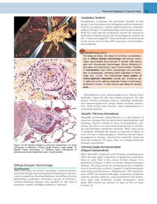 Diffuse Alveolar Hemorrhage
SyndromesWhile there may be several “secondary” causes of pulmo-
nary hemorrhage (necrotizing bacterial pneumonia, passive
venous congestion, bleeding diathesis), the diffuse alveolar
hemorrhage syndromes constitute a group of “primary”
immune-mediated diseases that manifest as the triad of
hemoptysis, anemia, and diffuse pulmonary inﬁltrates.
A
B
C
Figure 12–28 Vascular changes in pulmonary hypertension. A, Gross
photograph of atheroma, a ﬁnding usually limited to large vessels. B,
Marked medial hypertrophy. C, Plexiform lesion characteristic of
advanced pulmonary hypertension seen in small arteries.
Pulmonary Diseasesof Vascular Origin 485
Goodpasture Syndrome
Goodpasture syndrome, the prototype disorder of this
group, is an uncommon but intriguing condition character-
ized by a proliferative, usually rapidly progressive, glomerulo-
nephritis (Chapter 13) and hemorrhagic interstitialpneumonitis.
Both the renal and the pulmonary lesions are caused by
antibodies targeted against the noncollagenous domain of
the  3 chain of collagen IV. These antibodies can be detected
in the serum of more than 90% of persons with Goodpas-
ture syndrome.
MORPHOLOGY
The lungs are heavy, with areas of red-brown consolidation,
due to diffuse alveolar hemorrhage. Microscopic exami-
nation demonstrates focal necrosis of alveolar walls associ-
ated with intra-alveolar hemorrhages, ﬁbrous thickening of
the septa, and hypertrophic type II pneumocytes. Presence
of hemosiderin, both within macrophages and extracellu-
larly, is characteristic, indicating earlier episode(s) of hemor-
rhage (Fig. 12–29). The characteristic linear pattern of
immunoglobulin deposition (usually IgG, sometimes IgA
or IgM) that is the hallmark diagnostic ﬁnding in renal biopsy
specimens (Chapter 13) also may be seen along the alveolar
septa.
Plasmapheresis and immunosuppressive therapy have
markedly improved the once-dismal prognosis for this
disease. Plasma exchange removes offending antibodies,
and immunosuppressive drugs inhibit antibody produc-
tion. With severe renal disease, renal transplantation is
eventually required.
Idiopathic PulmonaryHemosiderosis
Idiopathic pulmonary hemosiderosis is a rare disease of
uncertain etiology that has pulmonary manifestations and
histologic features similar to those of Goodpasture syn-
drome, but there is no associated renal disease or circulat-
ing anti-basement membrane antibody. Most cases occur
in children, although the disease is reported in adults as
well, who have a better prognosis. With steroid and immu-
nosuppressive therapy, survival has markedly improved
from the historical 2.5 years; thus, an immune-mediated
etiology is postulated.
PulmonaryAngiitisandGranulomatosis
(Wegener Granulomatosis)
More than 80% of patients with Wegener granulomatosis
(WG) develop upper respiratory or pulmonary manifesta-
tions at some time in the course of their disease. It is
described in Chapter 9. Here we list the salient pulmonary
features. The lung lesions are characterized by a combina-
tion of necrotizing vasculitis (“angiitis”) and parenchymal
necrotizing granulomatous inﬂammation. The manifesta-
tions of WG can include both upper respiratory symptoms
(chronic sinusitis, epistaxis, nasal perforation) and pulmo-
nary signs and symptoms (cough, hemoptysis, chest
pain). PR3-ANCAs are present in close to 95% of cases
(Chapter 9).
 