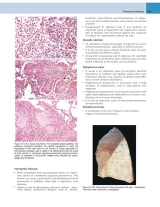 A
B
C
Figure 12–32 A, Acute pneumonia. The congested septal capillaries and
extensive neutrophil exudation into alveoli correspond to early red
hepatization. Fibrin nets have not yet formed. B, Early organization of
intra-alveolar exudates, seen in areas to be streaming through the pores
of Kohn (arrow). C, Advanced organizing pneumonia, featuring transfor-
mation of exudates to ﬁbromyxoid masses richly inﬁltrated by macro-
phages and ﬁbroblasts.
Figure 12–33 Gross view of lobar pneumonia with gray hepatization.
with chronic pulmonary diseases such as chronic The lower lobe isuniformly consolidated.
Haemophilus inﬂuenzae
• Both encapsulated and unencapsulated forms are impor-
tant causes of community-acquired pneumonias. The
former can cause a particularly life-threatening form of
pneumonia in children, often after a respiratory viral
infection.
• Adults at risk for developing infections include those
Pulmonary Infections 489
bronchitis, cystic ﬁbrosis, and bronchiectasis. H. inﬂuen-
zae is the most common bacterial cause of acute exacerbation
of COPD.
• Encapsulated H. inﬂuenzae type b was formerly an
important cause of epiglottitis and suppurative menin-
gitis in children, but vaccination against this organism
in infancy has signiﬁcantly reduced the risk.
Moraxella catarrhalis
• M. catarrhalis is being increasingly recognized as a cause
of bacterial pneumonia, especially in elderly persons.
• It is the second most common bacterial cause of acute
exacerbation of COPD in adults.
• Along with S. pneumoniae and H. inﬂuenzae, M. catarrhalis
constitutes one of the three most common causes of otitis
media (infection of the middle ear) in children.
Staphylococcus aureus
• S. aureus is an important cause of secondary bacterial
pneumonia in children and healthy adults after viral
respiratory illnesses (e.g., measles in children and inﬂu-
enza in both children and adults).
• Staphylococcal pneumonia is associated with a high
incidence of complications, such as lung abscess and
empyema.
• Staphylococcal pneumonia occurring in association with
right-sided staphylococcal endocarditis is a serious com-
plication of intravenous drug abuse.
• It is also an important cause of nosocomial pneumonia
(discussed later).
Klebsiella pneumoniae
• K. pneumoniae is the most frequent cause of gram-
negative bacterial pneumonia.
 