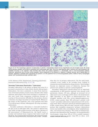 496 C H A P T E R
12
Lung
than they are in primary tuberculosis. On the other hand,
cavitation occurs readily in the secondary form, leading to
erosion into and dissemination along airways. Such changes
become an important source of infectivity, because the
patient now produces sputum containing bacilli.
Secondary tuberculosis should always be an important
consideration in HIV-positive patients who present with
pulmonary disease. Of note, although an increased risk of
tuberculosis exists at all stages of HIV disease, the manifestations
differ depending on the degree of immunosuppression. For
example, patients with less severe immunosuppression
(CD4+ counts greater than 300 cells/mm3
) present with
“usual” secondary tuberculosis (apical disease with cavita-
tion) while those with more advanced immunosuppression
(CD4+ counts below 200 cells/mm3
) present with a clinical
picture that resembles progressive primary tuberculosis
(lower and middle lobe consolidation, hilar lymphadenop-
athy, and noncavitary disease). The extent of immunosup-
pression also determines the frequency of extrapulmonary
involvement, rising from 10% to 15% in mildly immuno-
suppressed patients to greater than 50% in those with
in the absence of the characteristic caseating granulomas
(nonreactive tuberculosis) (Fig. 12–37, D).
SecondaryTuberculosis (Reactivation Tuberculosis)
Secondary tuberculosis is the pattern of disease that arises in a
previously sensitized host. It may follow shortly after primary
tuberculosis, but more commonly it arises from reactiva-
tion of dormant primary lesions many decades after initial
infection, particularly when host resistance is weakened. It
also may result from exogenous reinfection because of
waning of the protection afforded by the primary disease
or because of a large inoculum of virulent bacilli. Whatever
the source of the organism, only a few patients (less than
5%) with primary disease subsequently develop secondary
tuberculosis.
Secondary pulmonary tuberculosis is classically localized to
the apex of one or both upper lobes. The reason is obscure but
may relate to high oxygen tension in the apices. Because of
the preexistence of hypersensitivity, the bacilli excite a
prompt and marked tissue response that tends to wall off
the focus. As a result of this localization, the regional lymph
A
nodes are less prominently involved early in the disease severe immune deﬁciency.
B
C D
Figure 12–37 The morphologic spectrum of tuberculosis. A and B, A characteristic tubercle at low magniﬁcation (A) and at higher power (B) shows
central granular caseation surrounded by epithelioid and multinucleate giant cells. This is the usual response seen in persons who have developed cell-
mediated immunity to the organism. Inset: Acid-fast stain shows rare positive organisms. C, Occasionally, even in immunocompetent patients,
tubercular granulomas may not show central caseation; hence, irrespective of the presence or absence of caseous necrosis, use of special stains for
acid-fast organisms is indicated when granulomas are present. D, In this specimen from an immunosuppressed patient, sheets of foamy macrophages
packed with mycobacteria are seen (acid-fast stain).
 