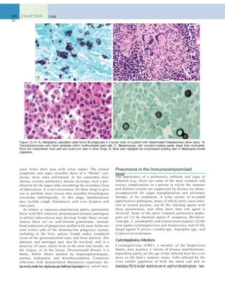 500 C H A P T E R
12
Lung
A B
C D
Figure 12–41 A, Histoplasma capsulatum yeast forms ﬁll phagocytes in a lymph node of a patient with disseminated histoplasmosis (silver stain). B,
Coccidioidomycosis with intact spherules within multinucleated giant cells. C, Blastomycosis, with rounded budding yeasts, larger than neutrophils.
Note the characteristic thick wall and nuclei (not seen in other fungi). D, Silver stain highlights the broad-based budding seen in Blastomyces immitis
organisms.
yeast forms (best seen with silver stains). The clinical
symptoms and signs resemble those of a “ﬂulike” syn-
drome, most often self-limited. In the vulnerable host,
chronic cavitary pulmonary disease develops, with a pre-
dilection for the upper lobe, resembling the secondary form
of tuberculosis. It is not uncommon for these fungi to give
rise to perihilar mass lesions that resemble bronchogenic
carcinoma radiologically. At this stage, manifestations
may include cough, hemoptysis, and even dyspnea and
chest pain.
In infants or immunocompromised adults, particularly
those with HIV infection, disseminated disease (analogous
to miliary tuberculosis) may develop. Under these circum-
stances there are no well-formed granulomas. Instead,
focal collections of phagocytes stuffed with yeast forms are
seen within cells of the mononuclear phagocyte system,
including in the liver, spleen, lymph nodes, lymphoid
tissue of the gastrointestinal tract, and bone marrow. The
adrenals and meninges may also be involved, and in a
minority of cases, ulcers form in the nose and mouth, on
the tongue, or in the larynx. Disseminated disease is a
hectic, febrile illness marked by hepatosplenomegaly,
anemia, leukopenia, and thrombocytopenia. Cutaneous
infections with disseminated Blastomyces organisms fre-
quently induce striking epithelial hyperplasia, which may
Pneumonia in the Immunocompromised
Host
be mistaken for squamous cell carcinoma. rounded by a clear halo (“owl’s eye”), which gives the
The appearance of a pulmonary inﬁltrate and signs of
infection (e.g., fever) are some of the most common and
serious complications in a person in whom the immune
and defense systems are suppressed by disease, by immu-
nosuppression for organ transplantation and antitumor
therapy, or by irradiation. A wide variety of so-called
opportunistic pathogens, many of which rarely cause infec-
tion in normal persons, can be the infecting agents with
these pneumonias, and often more than one agent is
involved. Some of the more common pulmonary patho-
gens are (1) the bacterial agents P. aeruginosa, Mycobacte-
rium spp., L. pneumophila, and Listeria monocytogenes; (2) the
viral agents cytomegalovirus and herpesvirus; and (3) the
fungal agents P. jiroveci, Candida spp., Aspergillus spp., and
Cryptococcus neoformans.
Cytomegalovirus Infections
Cytomegalovirus (CMV), a member of the herpesvirus
family, may produce a variety of disease manifestations,
depending partly on the age of the infected host but even
more on the host’s immune status. Cells infected by the
virus exhibit gigantism of both the entire cell and its
nucleus. Within the nucleus is an enlarged inclusion sur-
 