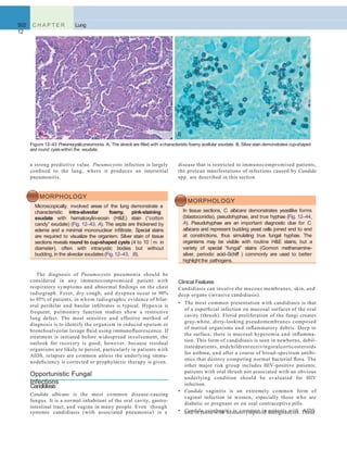 502 C H A P T E R
12
Lung
MORPHOLOGY
In tissue sections, C. albicans demonstrates yeastlike forms
(blastoconidia), pseudohyphae, and true hyphae (Fig. 12–44,
A). Pseudohyphae are an important diagnostic clue for C.
albicans and represent budding yeast cells joined end to end
at constrictions, thus simulating true fungal hyphae. The
organisms may be visible with routine H&E stains, but a
variety of special “fungal” stains (Gomori methenamine-
silver, periodic acid–Schiff ) commonly are used to better
highlightthe pathogens.
A B
Figure 12–43 Pneumocystispneumonia. A, The alveoli are ﬁlled with acharacteristic foamy acellular exudate. B, Silverstain demonstrates cup-shaped
and round cystswithin the exudate.
disease that is restricted to immunocompromised patients,
the protean manifestations of infections caused by Candida
spp. are described in this section.
a strong predictive value. Pneumocystis infection is largely
conﬁned to the lung, where it produces an interstitial
pneumonitis.
MORPHOLOGY
Microscopically, involved areas of the lung demonstrate a
characteristic intra-alveolar foamy, pink-staining
exudate with hematoxylin-eosin (H&E) stain (“cotton
candy” exudate) (Fig. 12–43, A). The septa are thickened by
edema and a minimal mononuclear inﬁltrate. Special stains
are required to visualize the organism. Silver stain of tissue
sections reveals round to cup-shaped cysts (4 to 10 m in
diameter), often with intracystic bodies but without
budding, in the alveolar exudates (Fig.12–43, B).
The diagnosis of Pneumocystis pneumonia should be
considered in any immunocompromised patient with
respiratory symptoms and abnormal ﬁndings on the chest
radiograph. Fever, dry cough, and dyspnea occur in 90%
to 95% of patients, in whom radiographic evidence of bilat-
eral perihilar and basilar inﬁltrates is typical. Hypoxia is
frequent; pulmonary function studies show a restrictive
lung defect. The most sensitive and effective method of
diagnosis is to identify the organism in induced sputum or
bronchoalveolar lavage ﬂuid using immunoﬂuorescence. If
treatment is initiated before widespread involvement, the
outlook for recovery is good; however, because residual
organisms are likely to persist, particularly in patients with
AIDS, relapses are common unless the underlying immu-
nodeﬁciency is corrected or prophylactic therapy is given.
systemic candidiasis (with associated pneumonia) is a and in those with hematolymphoid malignancies. These
Opportunistic Fungal
Infections
Candidiasis
Candida albicans is the most common disease-causing
fungus. It is a normal inhabitant of the oral cavity, gastro-
intestinal tract, and vagina in many people. Even though
Clinical Features
Candidiasis can involve the mucous membranes, skin, and
deep organs (invasive candidiasis).
• The most common presentation with candidiasis is that
of a superﬁcial infection on mucosal surfaces of the oral
cavity (thrush). Florid proliferation of the fungi creates
gray-white, dirty-looking pseudomembranes composed
of matted organisms and inﬂammatory debris. Deep to
the surface, there is mucosal hyperemia and inﬂamma-
tion. This form of candidiasis is seen in newborns, debil-
itatedpatients, andchildrenreceivingoralcorticosteroids
for asthma, and after a course of broad-spectrum antibi-
otics that destroy competing normal bacterial ﬂora. The
other major risk group includes HIV-positive patients;
patients with oral thrush not associated with an obvious
underlying condition should be evaluated for HIV
infection.
• Candida vaginitis is an extremely common form of
vaginal infection in women, especially those who are
diabetic or pregnant or on oral contraceptive pills.
• Candida esophagitis is common in patients with AIDS
 