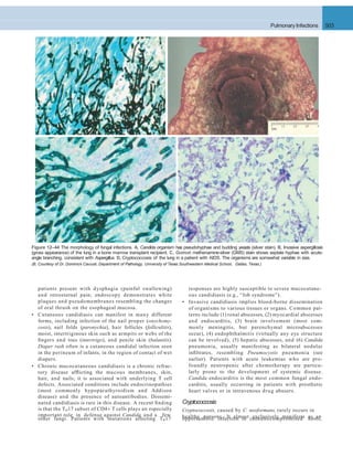 Pulmonary Infections 503
responses are highly susceptible to severe mucocutane-
ous candidiasis (e.g., “Job syndrome”).
• Invasive candidiasis implies blood-borne dissemination
of organisms to various tissues or organs. Common pat-
terns include (1) renal abscesses, (2) myocardial abscesses
and endocarditis, (3) brain involvement (most com-
monly meningitis, but parenchymal microabscesses
occur), (4) endophthalmitis (virtually any eye structure
can be involved), (5) hepatic abscesses, and (6) Candida
pneumonia, usually manifesting as bilateral nodular
inﬁltrates, resembling Pneumocystis pneumonia (see
earlier). Patients with acute leukemias who are pro-
foundly neutropenic after chemotherapy are particu-
larly prone to the development of systemic disease.
Candida endocarditis is the most common fungal endo-
carditis, usually occurring in patients with prosthetic
heart valves or in intravenous drug abusers.
Cryptococcosis
Cryptococcosis, caused by C. neoformans, rarely occurs in
healthy persons. It almost exclusively manifests as an
patients present with dysphagia (painful swallowing)
and retrosternal pain; endoscopy demonstrates white
plaques and pseudomembranes resembling the changes
of oral thrush on the esophageal mucosa.
• Cutaneous candidiasis can manifest in many different
forms, including infection of the nail proper (onychomy-
cosis), nail folds (paronychia), hair follicles (folliculitis),
moist, intertriginous skin such as armpits or webs of the
ﬁngers and toes (intertrigo), and penile skin (balanitis).
Diaper rash often is a cutaneous candidal infection seen
in the perineum of infants, in the region of contact of wet
diapers.
• Chronic mucocutaneous candidiasis is a chronic refrac-
tory disease afﬂicting the mucous membranes, skin,
hair, and nails; it is associated with underlying T cell
defects. Associated conditions include endocrinopathies
(most commonly hypoparathyroidism and Addison
disease) and the presence of autoantibodies. Dissemi-
nated candidiasis is rare in this disease. A recent ﬁnding
is that the TH17 subset of CD4+ T cells plays an especially
important role in defense against Candida and a few
A
other fungi. Patients with mutations affecting TH17 opportunistic infection in immunocompromised hosts,
B
C D
Figure 12–44 The morphology of fungal infections. A, Candida organism has pseudohyphae and budding yeasts (silver stain). B, Invasive aspergillosis
(gross appearance) of the lung in a bone marrow transplant recipient. C, Gomori methenamine-silver (GMS) stain shows septate hyphae with acute-
angle branching, consistent with Aspergillus. D, Cryptococcosis of the lung in a patient with AIDS. The organisms are somewhat variable in size.
(B, Courtesy of Dr. Dominick Cavuoti, Department of Pathology, University of Texas Southwestern Medical School, Dallas, Texas.)
 