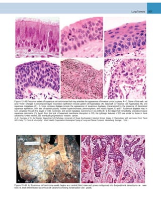 Lung Tumors 507
A B
Figure 12–46 A, Squamous cell carcinoma usually begins as a central (hilar) mass and grows contiguously into the peripheral parenchyma as seen
A
here. B, Well-differentiated squamous cell carcinoma showing keratinization and pearls.
B C
D E F
Figure 12–45 Precursor lesions of squamous cell carcinomas that may antedate the appearance of invasive tumor by years. A–C, Some of the earli- est
(and “mild”) changes in smoking-damaged respiratory epithelium include goblet cell hyperplasia (A), basal cell (or reserve cell) hyperplasia (B), and
squamous metaplasia (C). D, More ominous changes include the appearance of squamous dysplasia, characterized by the presence of disordered
squamous epithelium, with loss of nuclear polarity, nuclear hyperchromasia, pleomorphism, and mitotic ﬁgures. E and F, Squamous dysplasia may, in
turn, progress through the stages of mild, moderate, and severe dysplasia. Carcinoma in situ (CIS) (E) is the stage that immediately precedes invasive
squamous carcinoma (F). Apart from the lack of basement membrane disruption in CIS, the cytologic features of CIS are similar to those in frank
carcinoma. Unless treated, CIS eventually progressesto invasive cancer.
(A–E, Courtesy of Dr. Adi Gazdar, Department of Pathology, University of Texas Southwestern Medical School, Dallas. F, Reproduced with permission from Travis
WD, Colby TV, Corrin B, et al [eds]: World Health Organization Histological Typing of Lung and Pleural Tumours. Heidelberg, Springer, 1999.)
 