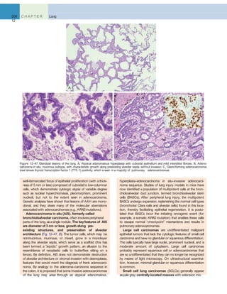 508 C H A P T E R
12
Lung
A
B C
Figure 12–47 Glandular lesions of the lung. A, Atypical adenomatous hyperplasia with cuboidal epithelium and mild interstitial ﬁbrosis. B, Adeno-
carcinoma in situ, mucinous subtype, with characteristic growth along preexisting alveolar septa, without invasion. C, Gland-forming adenocarcinoma;
inset shows thyroid transcription factor 1 (TTF-1) positivity, which isseen in a majority of pulmonary adenocarcinomas.
well-demarcated focus of epithelial proliferation (with a thick-
ness of 5 mm or less) composed of cuboidal to low-columnar
cells, which demonstrate cytologic atypia of variable degree
such as nuclear hyperchromasia, pleomorphism, prominent
nucleoli, but not to the extent seen in adenocarcinoma.
Genetic analyses have shown that lesions of AAH are mono-
clonal, and they share many of the molecular aberrations
associated with adenocarcinomas(e.g., K-RASmutations).
Adenocarcinoma in situ (AIS), formerly called
bronchioloalveolar carcinoma, often involves peripheral
parts of the lung, asa single nodule. The keyfeatures of AIS
are diameter of 3 cm or less, growth along pre-
existing structures, and preservation of alveolar
architecture (Fig. 12–47, B). The tumor cells, which may be
nonmucinous, mucinous, or mixed, grow in a monolayer
along the alveolar septa, which serve as a scaffold (this has
been termed a “lepidic” growth pattern, an allusion to the
resemblance of neoplastic cells to butterﬂies sitting on a
fence). By deﬁnition, AIS does not demonstrate destruction
of alveolar architecture or stromal invasion with desmoplasia,
features that would merit the diagnosis of frank adenocarci-
noma. By analogy to the adenoma–carcinoma sequence in
the colon, it is proposed that some invasive adenocarcinomas
of the lung may arise through an atypical adenomatous
hyperplasia–adenocarcinoma in situ–invasive adenocarci-
noma sequence. Studies of lung injury models in mice have
now identiﬁed a population of multipotent cells at the bron-
chioloalveolar duct junction, termed bronchioalveolar stem
cells (BASCs). After peripheral lung injury, the multipotent
BASCs undergo expansion, replenishing the normal cell types
(bronchiolar Clara cells and alveolar cells) found in this loca-
tion, thereby facilitating epithelial regeneration. It is postu-
lated that BASCs incur the initiating oncogenic event (for
example, a somatic K-RAS mutation) that enables these cells
to escape normal “checkpoint” mechanisms and results in
pulmonary adenocarcinomas.
Large cell carcinomas are undifferentiated malignant
epithelial tumors that lack the cytologic features of small cell
carcinoma and have no glandular or squamous differentiation.
The cells typically have large nuclei, prominent nucleoli, and a
moderate amount of cytoplasm. Large cell carcinomas
probably represent squamous cell or adenocarcinomas that
are so undifferentiated that they can no longer be recognized
by means of light microscopy. On ultrastructural examina-
tion, however, minimal glandular or squamous differentiation
iscommon.
Small cell lung carcinomas (SCLCs) generally appear
aspale gray, centrally located masses with extension into
 