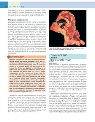 Figure 12–50 Malignant mesothelioma. Note the thick, ﬁrm, white
pleural tumor that ensheathes this bisected lung.
512 C H A P T E R 12 Lung
of ﬂuid may not be large, but chylothorax is always signiﬁ-
cant because it implies obstruction of the major lymph
ducts, usually by an intrathoracic cancer (e.g., a primary or
secondary mediastinal neoplasm, such as a lymphoma).
Malignant Mesothelioma
Malignant mesothelioma is a rare cancer of mesothelial
cells, usually arising in the parietal or visceral pleura,
although it also occurs, much less commonly, in the peri-
toneum and pericardium. It has assumed great importance
because it is related to occupational exposure to asbestos
in the air. Approximately 50% of persons with this cancer
have a history of exposure to asbestos. Those who work
directly with asbestos (shipyard workers, miners, insula-
tors) are at greatest risk, but malignant mesotheliomas
have appeared in persons whose only exposure was living
in proximity to an asbestos factory or being a relative of an
asbestos worker. The latent period for developing malig-
nant mesothelioma is long, often 25 to 40 years after initial
asbestos exposure, suggesting that multiple somatic genetic
events are required for neoplastic conversion of a mesothe-
lial cell. As stated earlier, the combination of cigarette smoking
and asbestos exposure greatly increases the risk of lung carci-
noma, but it does not increase the risk of developing malignant
mesothelioma.
MORPHOLOGY
Malignant mesotheliomas are often preceded by extensive
pleural ﬁbrosis and plaque formation, readily seen on
computed tomography scans. These tumors begin in a local-
ized area and over time spread widely, either by contiguous
growth or by diffusely seeding the pleural surfaces. At
autopsy, the affected lung typically is ensheathed by a
yellow-white, ﬁrm, sometimes gelatinous layer of tumor
that obliterates the pleural space (Fig. 12–50). Distant
metastases are rare. The neoplasm may directly invade the
thoracic wall or the subpleural lung tissue. Normal mesothe-
lial cells are biphasic, giving rise to pleural lining cells as well
as the underlying ﬁbrous tissue. Therefore, histologically,
mesotheliomas conform to one of three patterns: (1) epi-
thelial, in which cuboidal cells line tubular and microcystic
spaces, into which small papillary buds project; this is the
most common pattern and also the one most likely to be
confused with a pulmonary adenocarcinoma; (2) sarcoma-
tous, in which spindled and sometimes ﬁbroblastic-appearing
cells grow in nondistinctive sheets; and (3) biphasic, having
both sarcomatous and epithelial areas.
Asbestos is not removed or metabolized from the lung,
so the ﬁbers remain in the body for life. Thus, the lifetime
risk after exposure does not diminish over time (unlike
with smoking, in which the risk decreases after cessation).
It has been hypothesized that asbestos ﬁbers preferentially
gather near the mesothelial cell layer, where they generate
reactive oxygen species, which cause DNA damage with
potentially oncogenic mutations. Somatic mutations of two
tumor suppressor genes (p16/CDKN2A, at chromosomal
locus 9p21, and NF2, at chromosomal locus 22q12) have
LESIONS OF THE
UPPER
RESPIRATORYTRACT
been observed in malignant mesotheliomas. poststreptococcal glomerulonephritis and acute rheumatic
Acute
InfectionsAcute infections of the upper respiratory tract are among
the most common afﬂictions of humans, most frequently
manifesting as the “common cold.” The clinical features are
well known: nasal congestion accompanied by watery dis-
charge; sneezing; scratchy, dry sore throat; and a slight
increase in temperature that is more pronounced in young
children. The most common pathogens are rhinoviruses,
but coronaviruses, respiratory syncytial viruses, parainﬂu-
enza and inﬂuenza viruses, adenoviruses, enteroviruses,
and sometimes even group A -hemolytic streptococci
have been implicated. In a signiﬁcant number of cases
(around 40%) the cause cannot be determined; perhaps
new viruses will be discovered. Most of these infections
occur in the fall and winter and are self-limiting (usually
lasting for a week or less). In a minority of cases, colds may
be complicated by the development of bacterial otitis media
or sinusitis.
In addition to the common cold, infections of the upper
respiratory tract may produce signs and symptoms local-
ized to the pharynx, epiglottis, or larynx. Acute pharyngitis,
manifesting as a sore throat, may be caused by a host of
agents. Mild pharyngitis with minimal physical ﬁndings
frequently accompanies a cold and is the most common
form of pharyngitis. More severe forms with tonsillitis,
associated with marked hyperemia and exudates, occur
with -hemolytic streptococcal and adenovirus infections.
Streptococcal tonsillitis is important to recognize and treat
early, because of the associated potential for development
of peritonsillar abscesses (“quinsy”) or for progression to
 