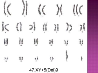 47,XY+5(Del)9
 