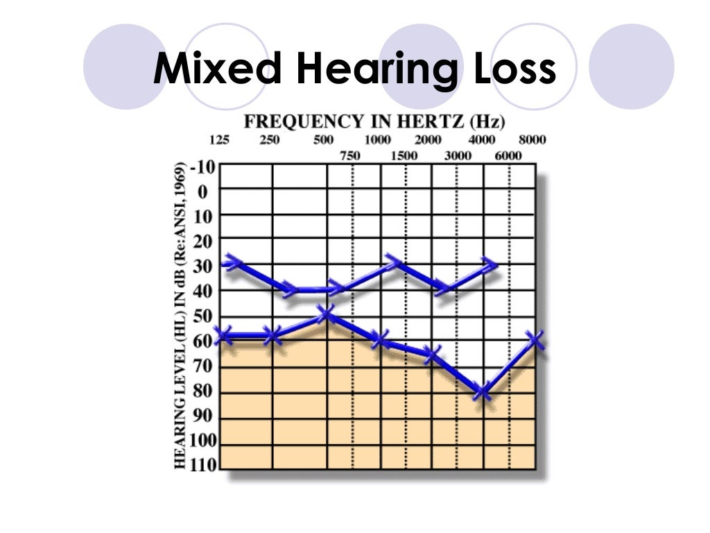 Reading an audiogram