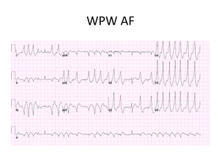 WPW AF
 