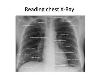 Reading chest X-Ray
 
