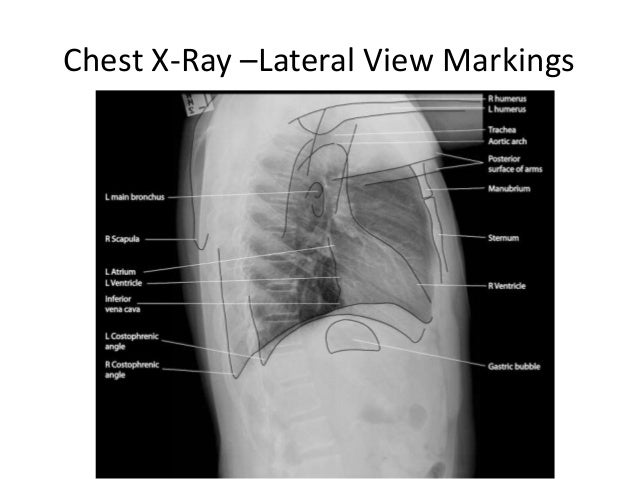Reading chest x ray