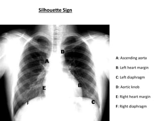 A: Ascending aorta
B: Left heart margin
C: Left diaphragm
D: Aortic knob
E: Right heart margin
F: Right diaphragm
Silhouette Sign
 