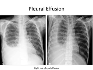 Pleural Effusion
Right side pleural effusion
 