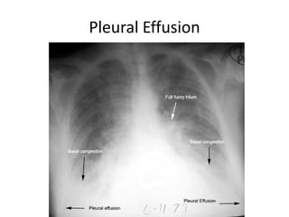 Pleural Effusion
 