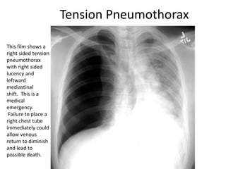 Tension Pneumothorax
This film shows a
right sided tension
pneumothorax
with right sided
lucency and
leftward
mediastinal
shift. This is a
medical
emergency.
Failure to place a
right chest tube
immediately could
allow venous
return to diminish
and lead to
possible death.
 