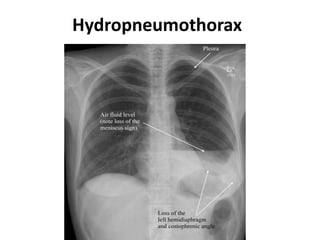 Hydropneumothorax
 