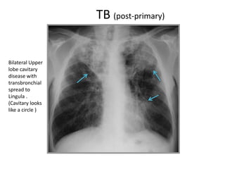 TB (post-primary)
Bilateral Upper
lobe cavitary
disease with
transbronchial
spread to
Lingula .
(Cavitary looks
like a circle )
 