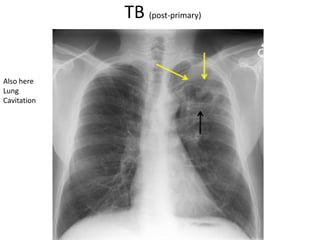 TB (post-primary)
Also here
Lung
Cavitation
 