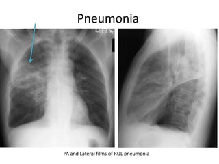 Pneumonia
PA and Lateral films of RUL pneumonia
 