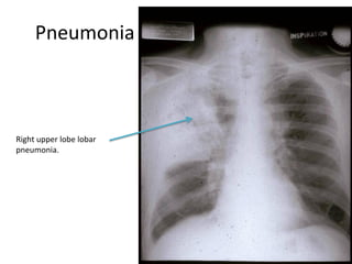 Pneumonia
Right upper lobe lobar
pneumonia.
 
