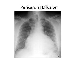 Pericardial Effusion
PA
 