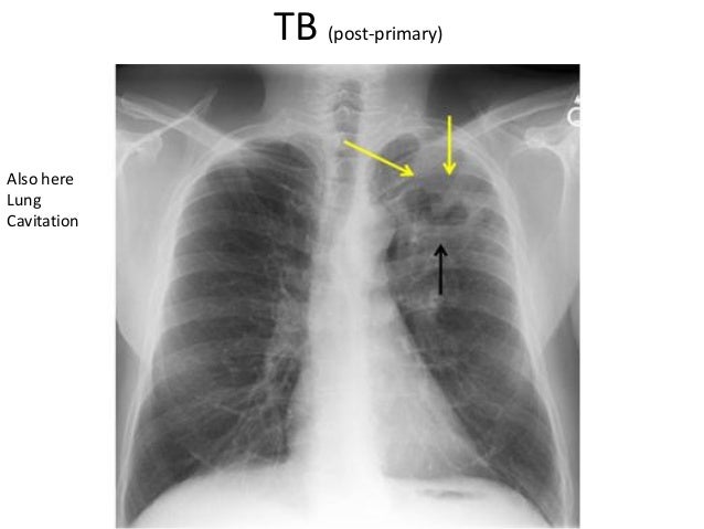 Reading chest X-ray