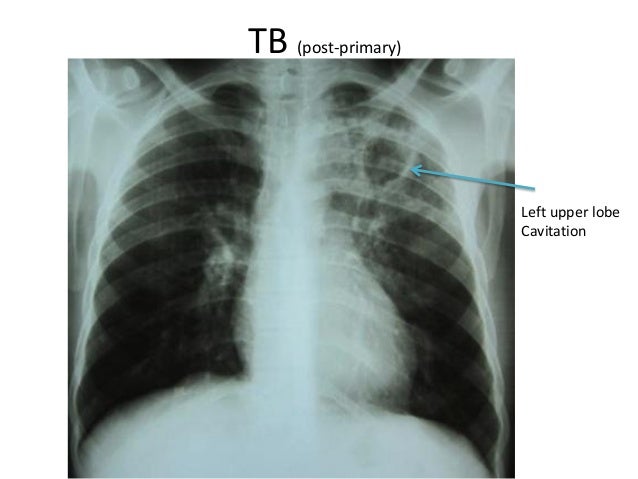 Reading chest X-ray