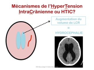 Augmentation du
volume de LCR
HYDROCEPHALIE
=	
Mécanismes de l’HyperTension
IntraCrânienne ou HTIC?
DES	Neurologie	15	décembre	2016	
 