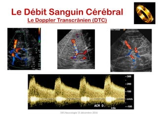 DES	Neurologie	15	décembre	2016	
Le Débit Sanguin Cérébral
Le Doppler Transcrânien (DTC)
 