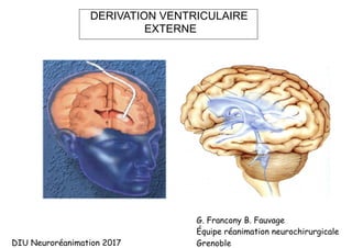 G. Francony B. Fauvage
Équipe réanimation neurochirurgicale
Grenoble
DERIVATION VENTRICULAIRE
EXTERNE
DIU Neuroréanimation 2017
 