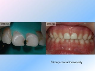 Cementation
Full-coverage zirconia-based
 restorations with adequate
retention do not require resin
     bonding for defin...
