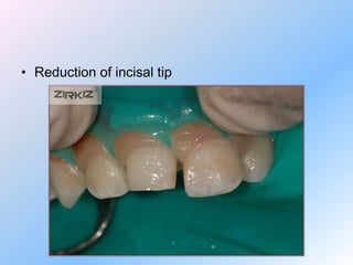 -If you grind ZIRKIZ crowns under the red line too much, it can be fractured
    because the cervical margin is really thi...