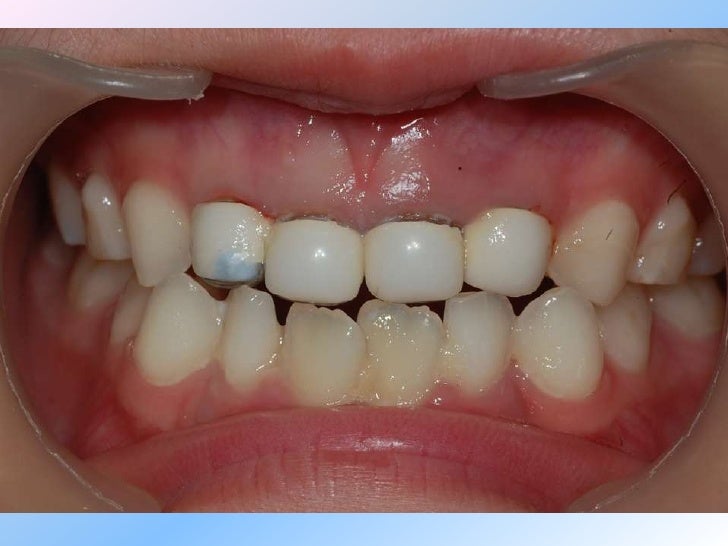 Ready made primary anterior crowns(zirkiz® crowns)120509