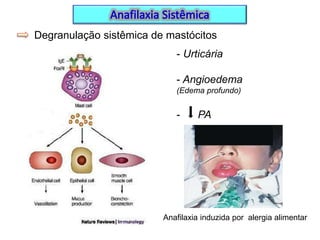 Degranulação sistêmica de mastócitos
- Urticária
- Angioedema
(Edema profundo)

-

PA

Anafilaxia induzida por alergia alimentar

 