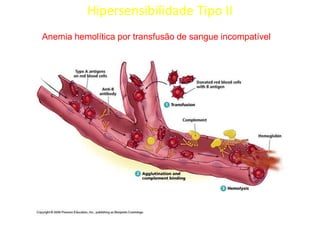 Hipersensibilidade Tipo II
Anemia hemolítica por transfusão de sangue incompatível

 