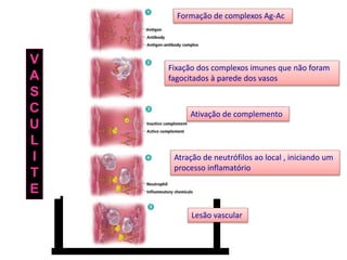 Formação de complexos Ag-Ac

V
A
S
C
U
L
I
T
E

Fixação dos complexos imunes que não foram
fagocitados à parede dos vasos

Ativação de complemento

Atração de neutrófilos ao local , iniciando um
processo inflamatório

Lesão vascular

 