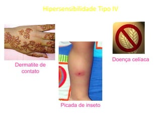 Hipersensibilidade Tipo IV

Doença celíaca

Dermatite de
contato

Picada de inseto

 