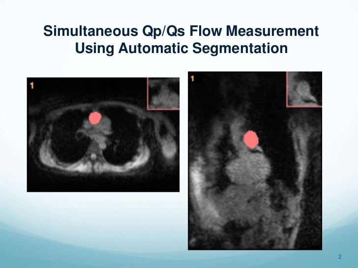 Real time qp qs measurement with automatic segementation