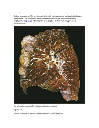 REAL GG PULMONAR d etoda la patología jajajs | PDF