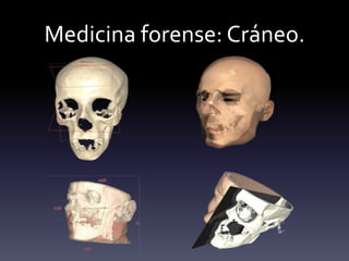 Medicina forense: Cráneo.