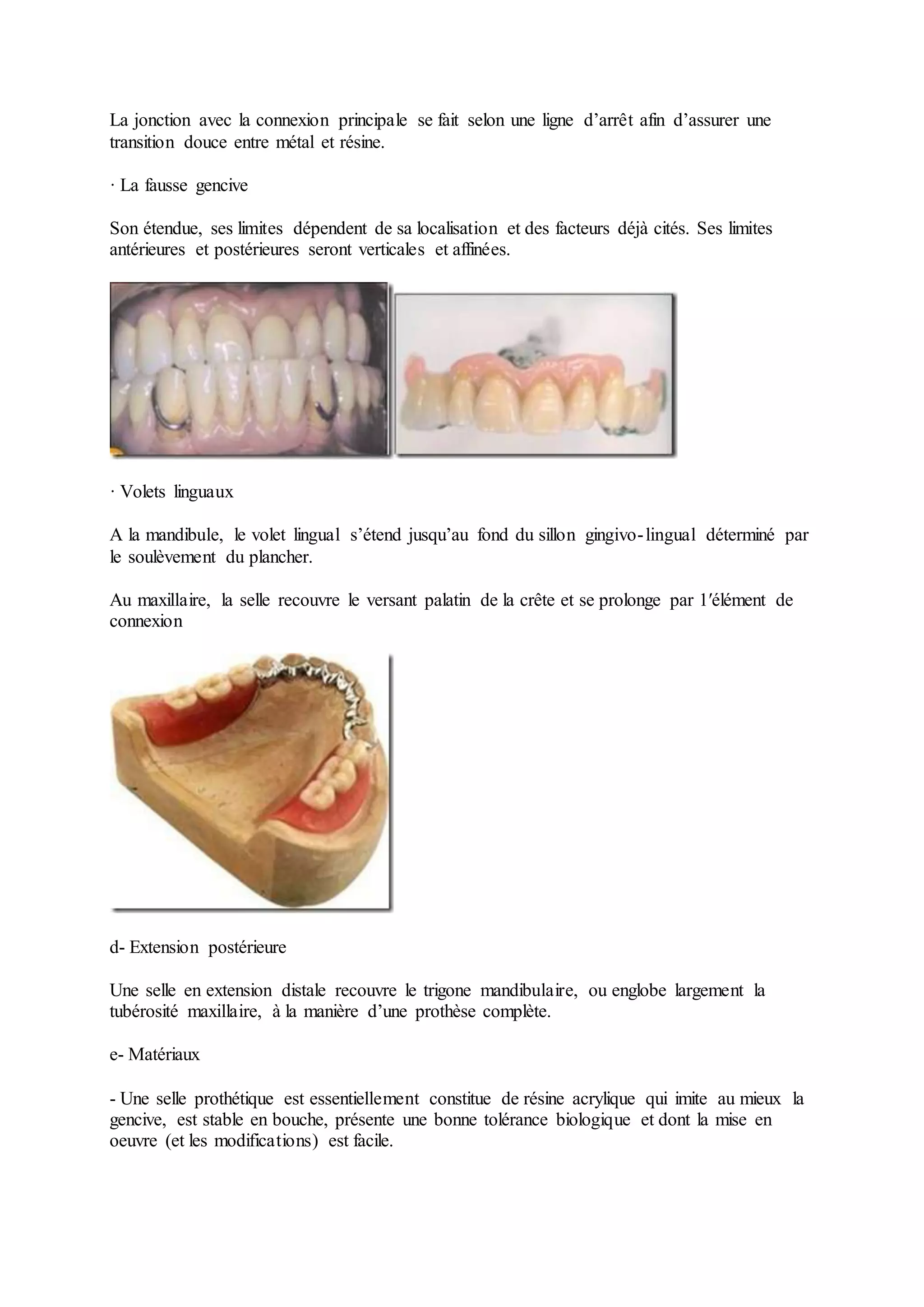 Prothèse Amovible Définitive à Châssis Métallique Comportant 6 Dents Realisation du chassis au laboratoire